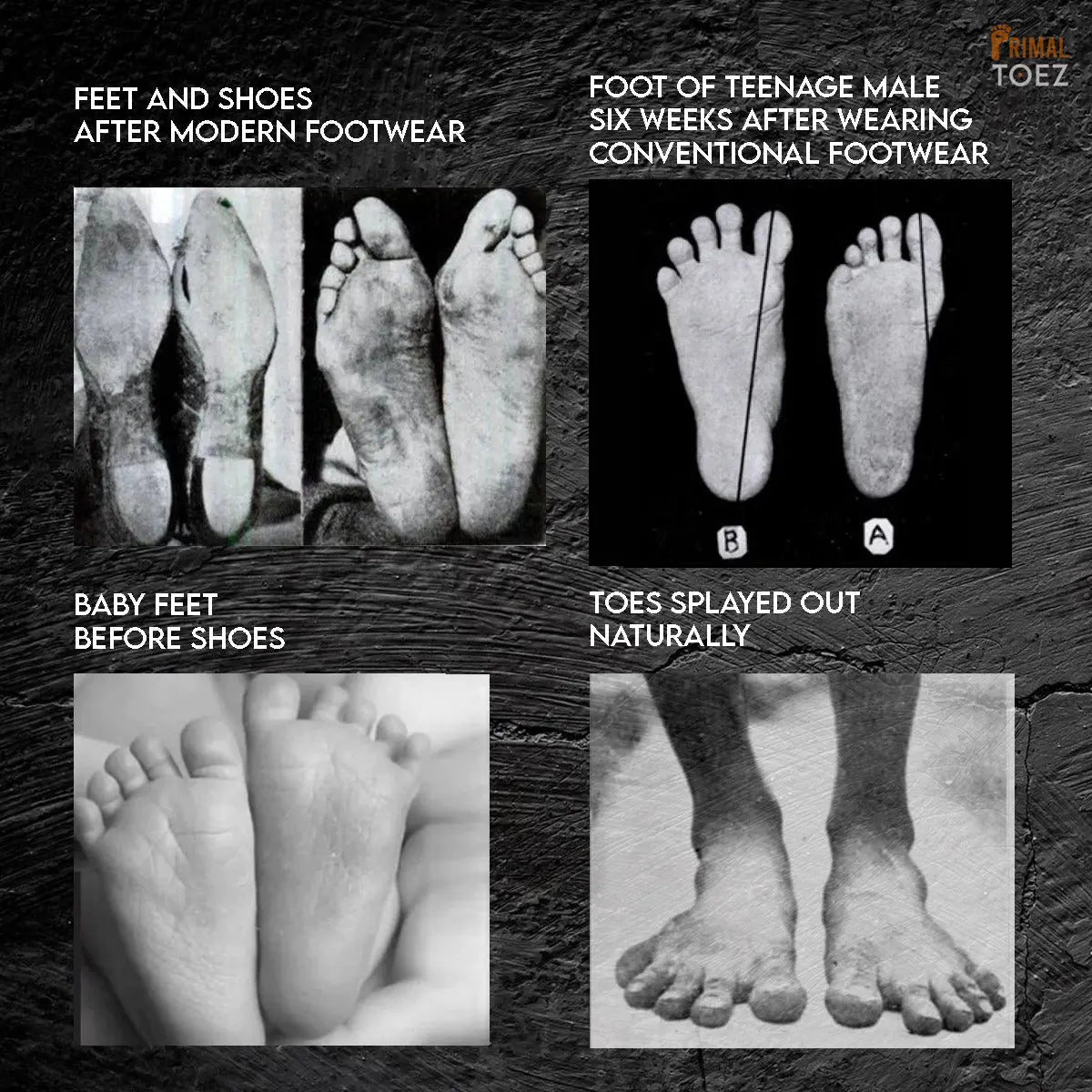 Primal Toez™ Deep Toe Spacers | 6-Piece Set | Foot Realignment & Pain Relief